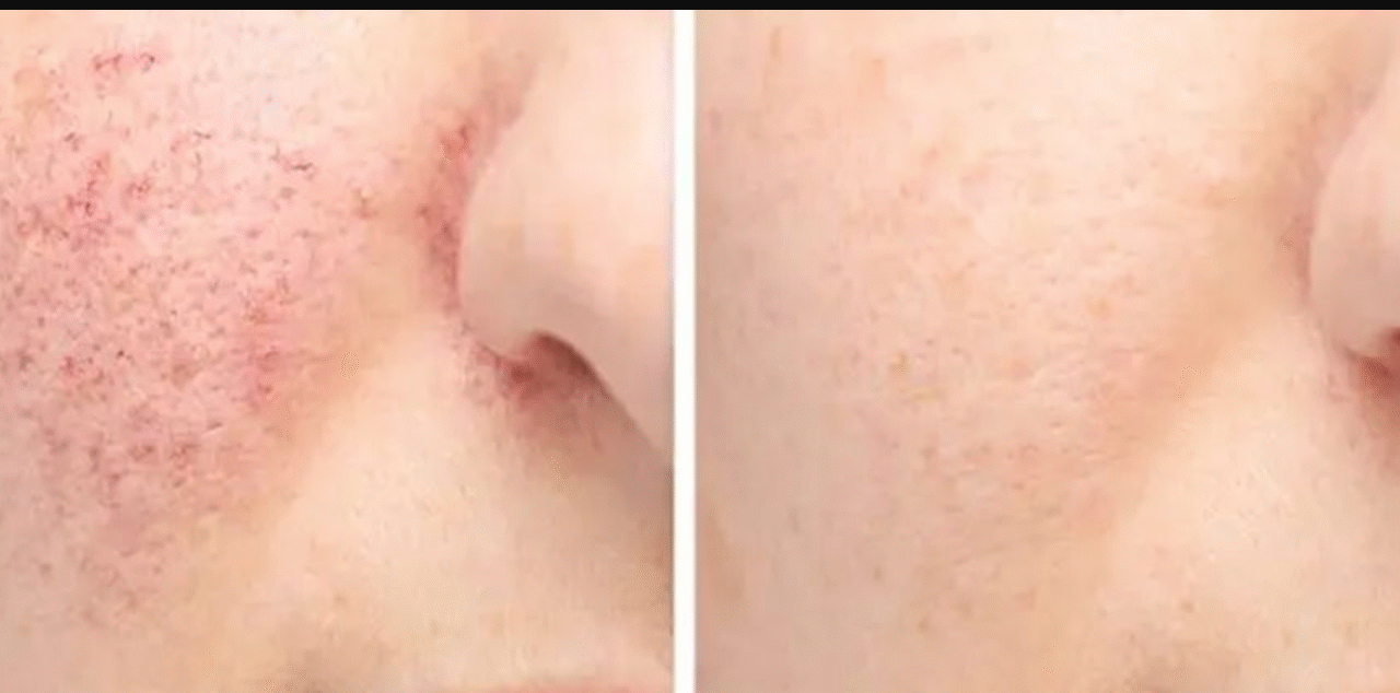 মুখের গর্ত নিয়ে চিন্তিত, জেনে নিন মসৃণ ত্বক ফিরে পাওয়ার উপায়