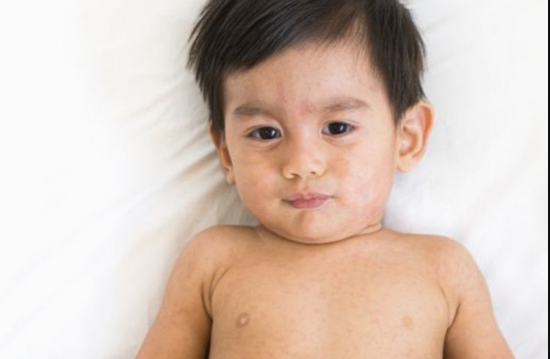 হাম থেকে শিশুকে বাঁচাতে যা জানা জরুরি