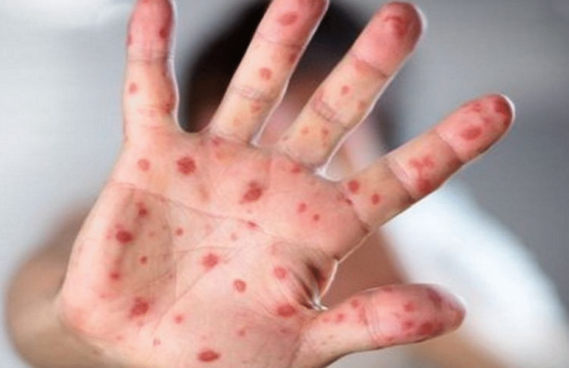 বাংলাদেশের ৫৬ জেলায় হাম ছড়িয়েছে, উদ্বিগ্ন বিশ্ব স্বাস্থ্য সংস্থা