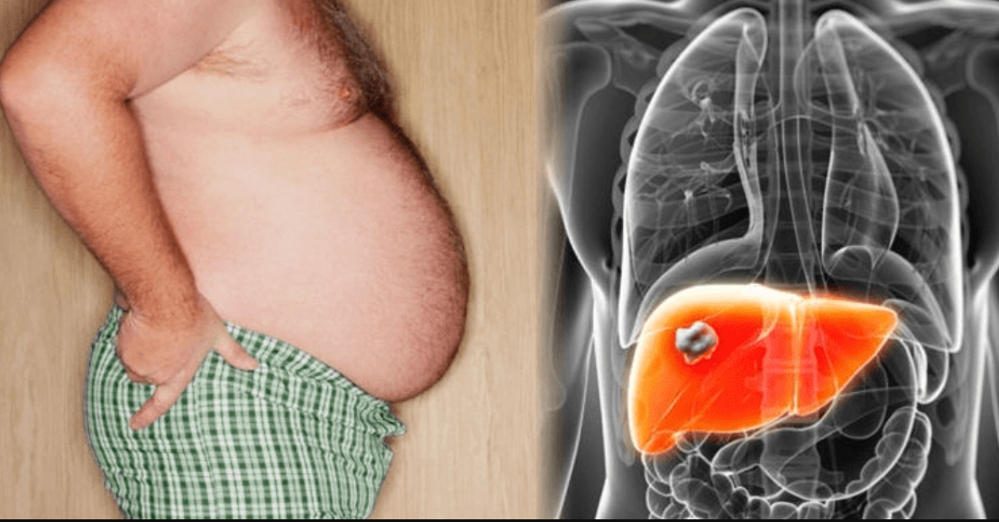 যেসব খাবার ফ্যাটি লিভারের জন্য দায়ী, লক্ষণগুলো কী