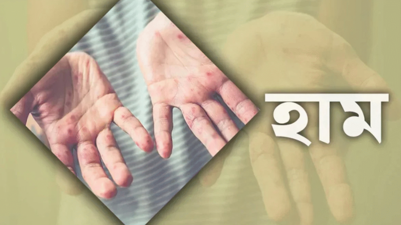 সিলেটে হামে আরও ৫ শিশুর মৃত্যু